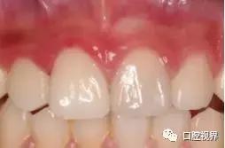 门牙撞了怎么办,门牙意外损坏怎么办