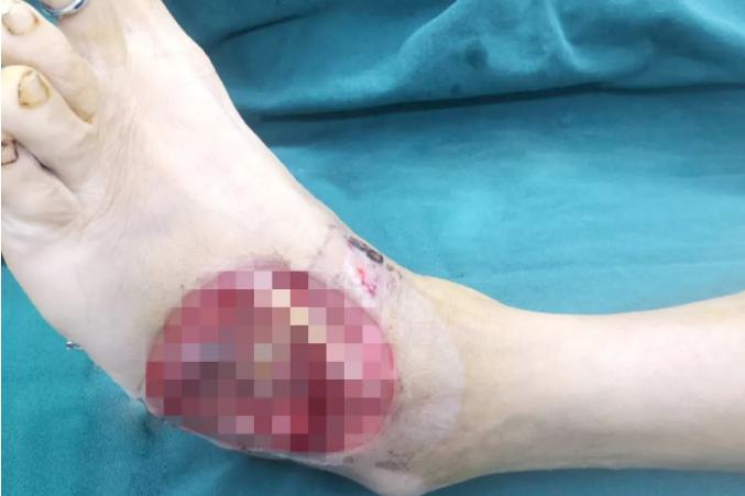 中年男子不慎撞伤左脚，手外科移花接木完美修复！
