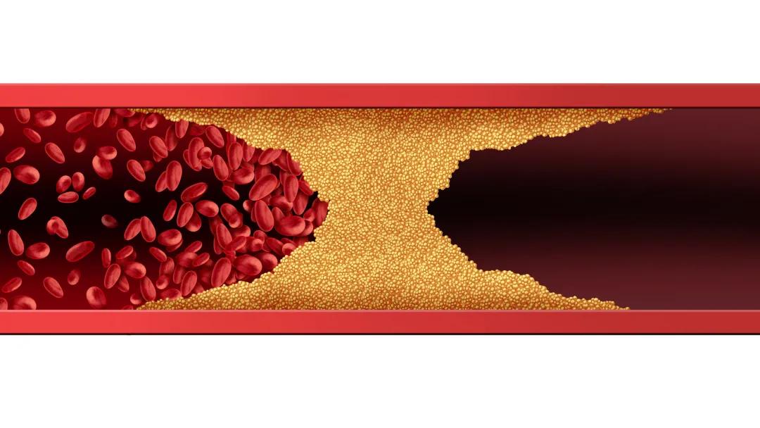 d二聚体高和吃的东西有关吗,单纯d二聚体升高但凝血功能正常