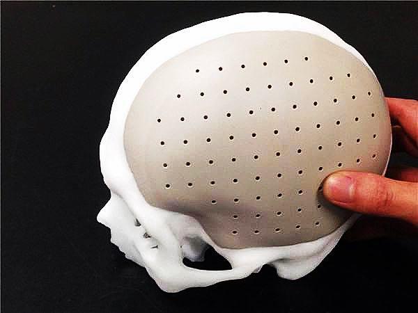 拯救大脑危机,颅骨缺损不补对大脑有影响吗