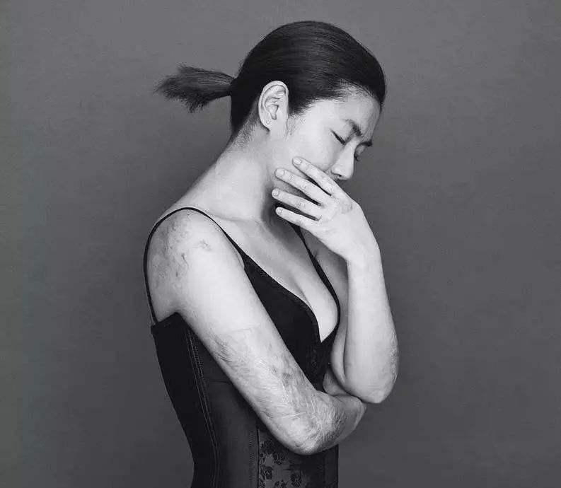 任家萱讲述烧伤经历,任家萱烧伤完整赔偿