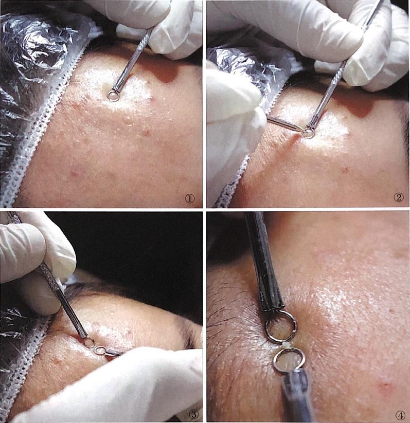 痘痘可以挤吗正确处理方法告诉你,教你正确的挤青春痘的方法