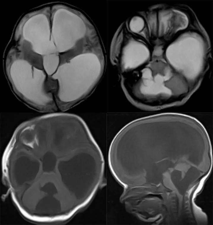 先天性颅脑发育不全,先天颅脑发育不良能治吗