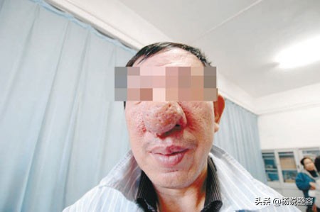 科普什么是酒渣鼻,科普一下你不知道的酒的小知识