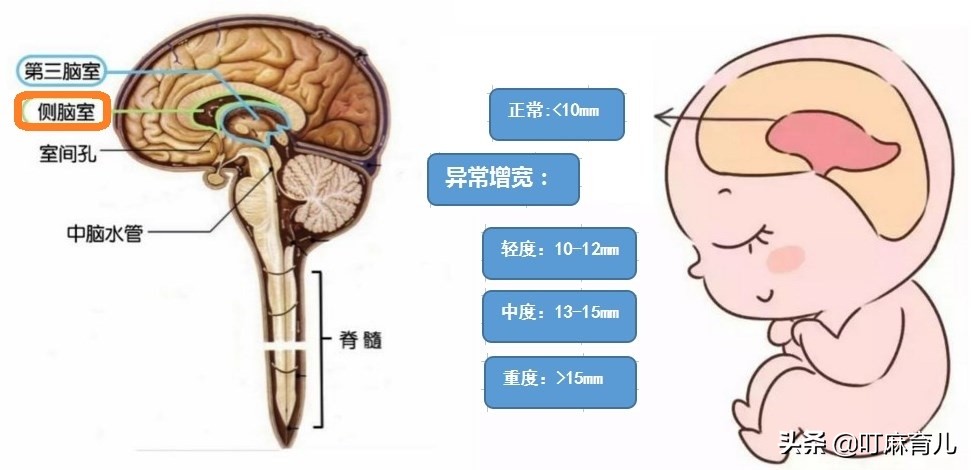孕6个月检查出胎儿脑积水04cm,孕36周查出孩子脑积水怎么办