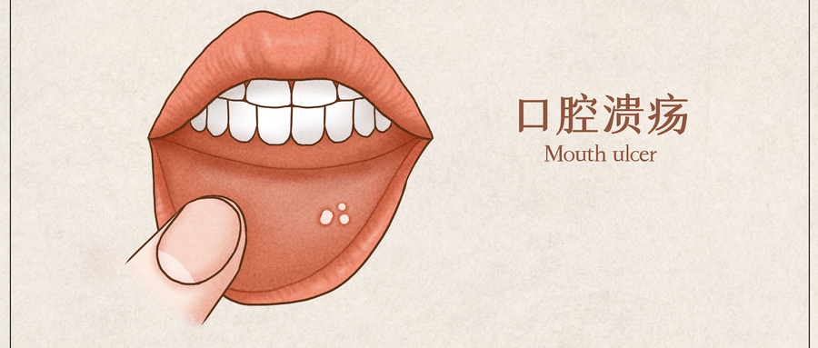宫颈癌化疗后口腔长了疮,宫颈癌放疗后外阴溃疡怎么办