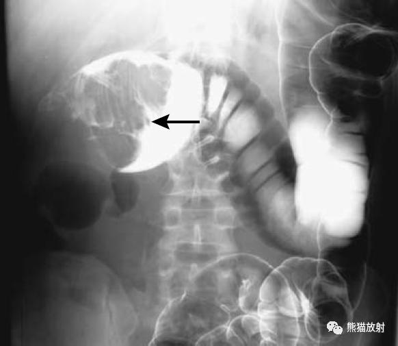 腹部影像图片大全,乙状直肠疼痛位置图片