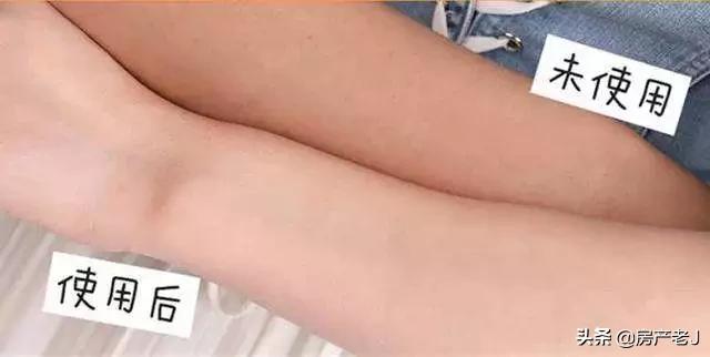 腿上长鱼鳞片状的皮屑怎么办,腿上起皮屑就是鱼鳞病