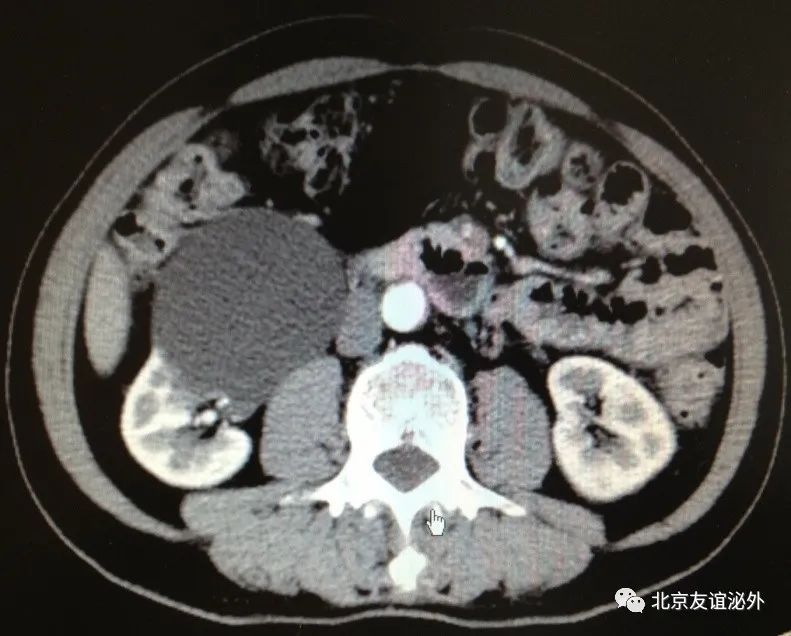 体检发现肾囊肿需不需要做手术,儿童体检发现肾囊肿
