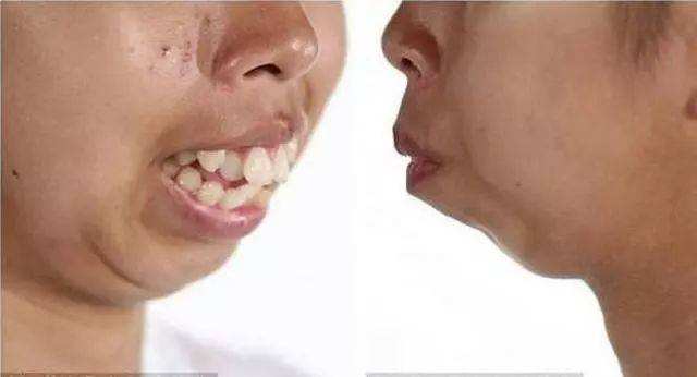 遗传龅牙可以矫正吗,龅牙遗传规律