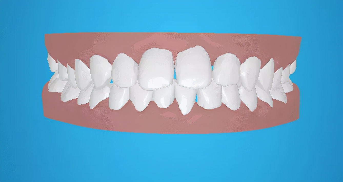 牙齿矫正真的可以提升颜值吗,牙齿矫正会让颜值提升