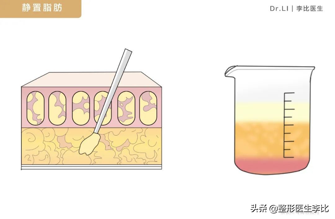 隆胸半年之后胸部有囊肿正常吗,脂肪隆胸以后胸部周围有小疙瘩