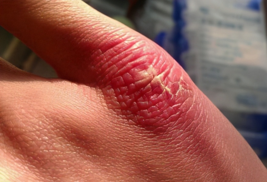 冻疮引起的白癜风会扩散吗,白癜风导致冻疮怎么治