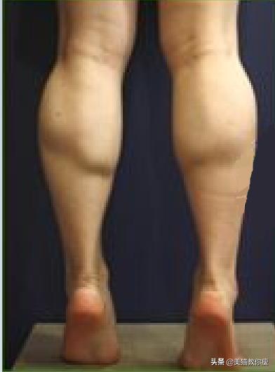 小学生肌肉腿怎么瘦成筷子腿,三天肌肉腿瘦成筷子腿