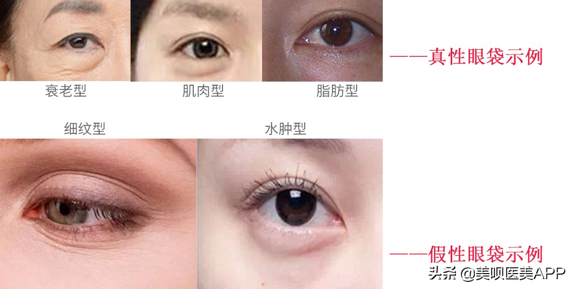 祛眼袋手术后多久恢复自然,西安哪家医院祛眼袋手术做的最好