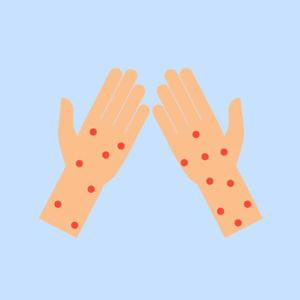 宝宝身上的痱子和热疹怎么区分,婴儿痱子和皮疹的区别