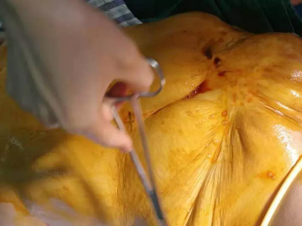 女子全身被大火烧伤新闻,女孩全身被大火重度烧伤