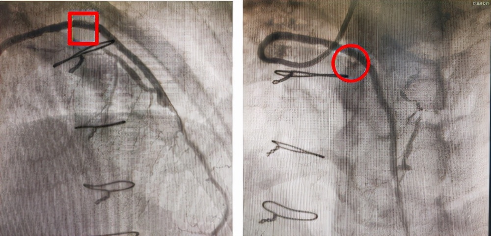 哈医大二院完成静脉桥血管再狭窄OCT指导下药物球囊介入治疗