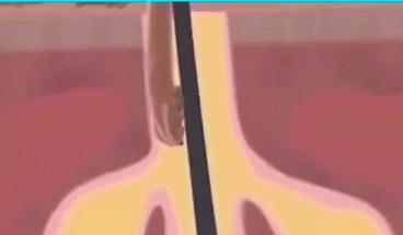 螨虫的天敌和去掉螨虫的方法,怎么去除螨虫和螨虫的尸体