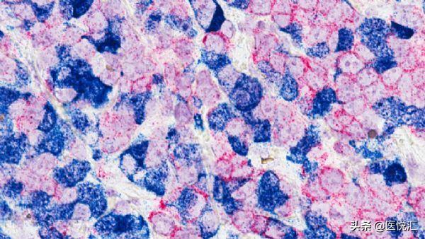 化疗免疫联合治疗肿瘤会缩小吗,姑息性化疗恶性肿瘤免疫治疗