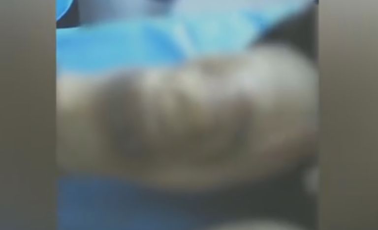 针灸后感染病例,针灸后针孔化脓