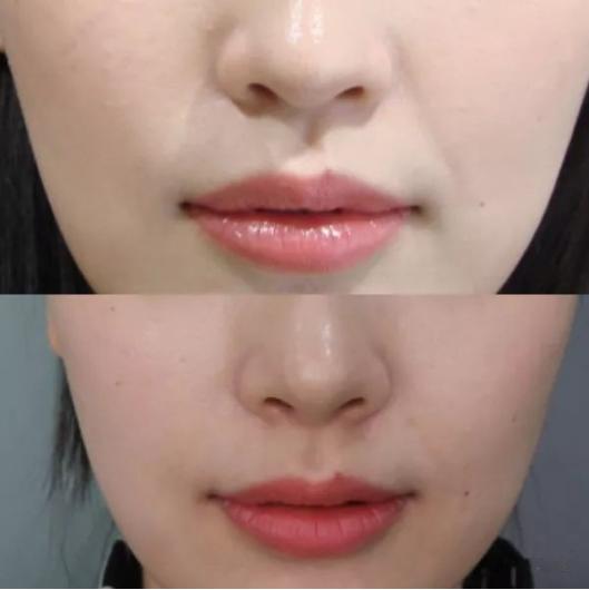 注射玻尿酸和肉毒素除皱皮肤紫红,肉毒素除皱后可以做玻尿酸填充吗