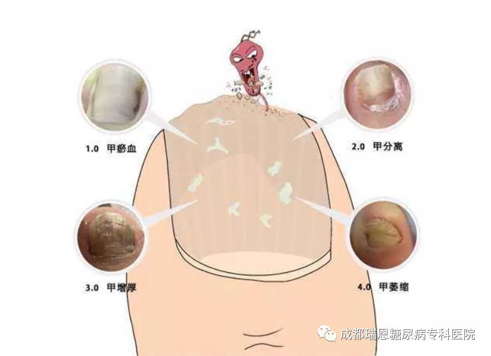 预防糖尿病并发症的药有哪些,糖尿病患者发生心血管疾病的危险