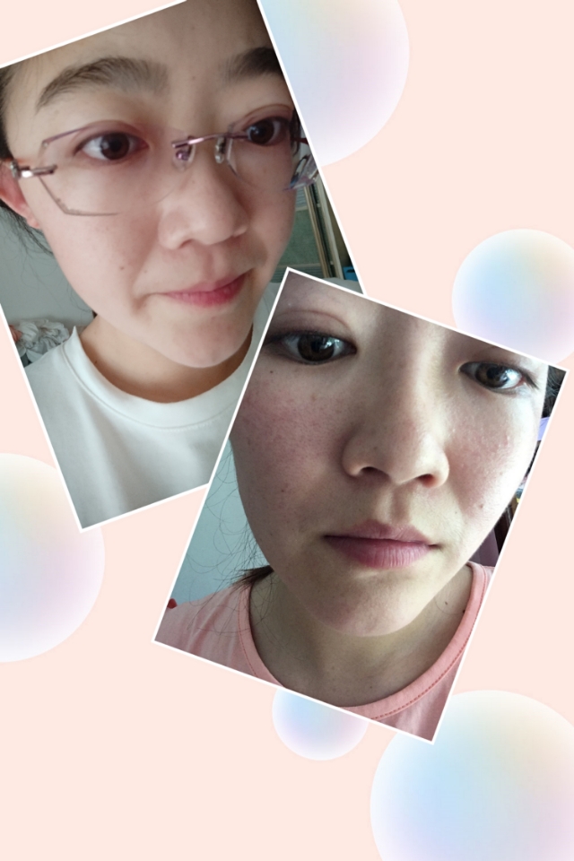 敏感肌长粉刺闭口怎么办,敏感肌发红发痒闭口怎么办