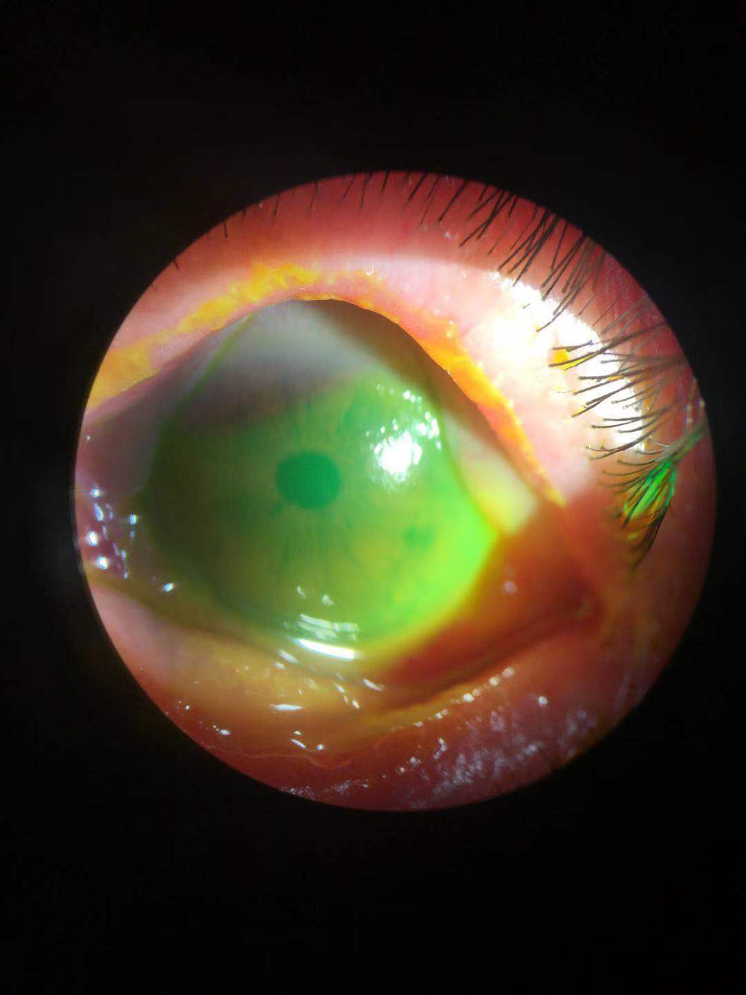 一滴甲对眼睛伤害,一滴碘伏一不小心掉进了眼里