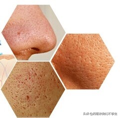 白醋洗脸控油还美白,白醋洗脸真的可以改善痤疮吗