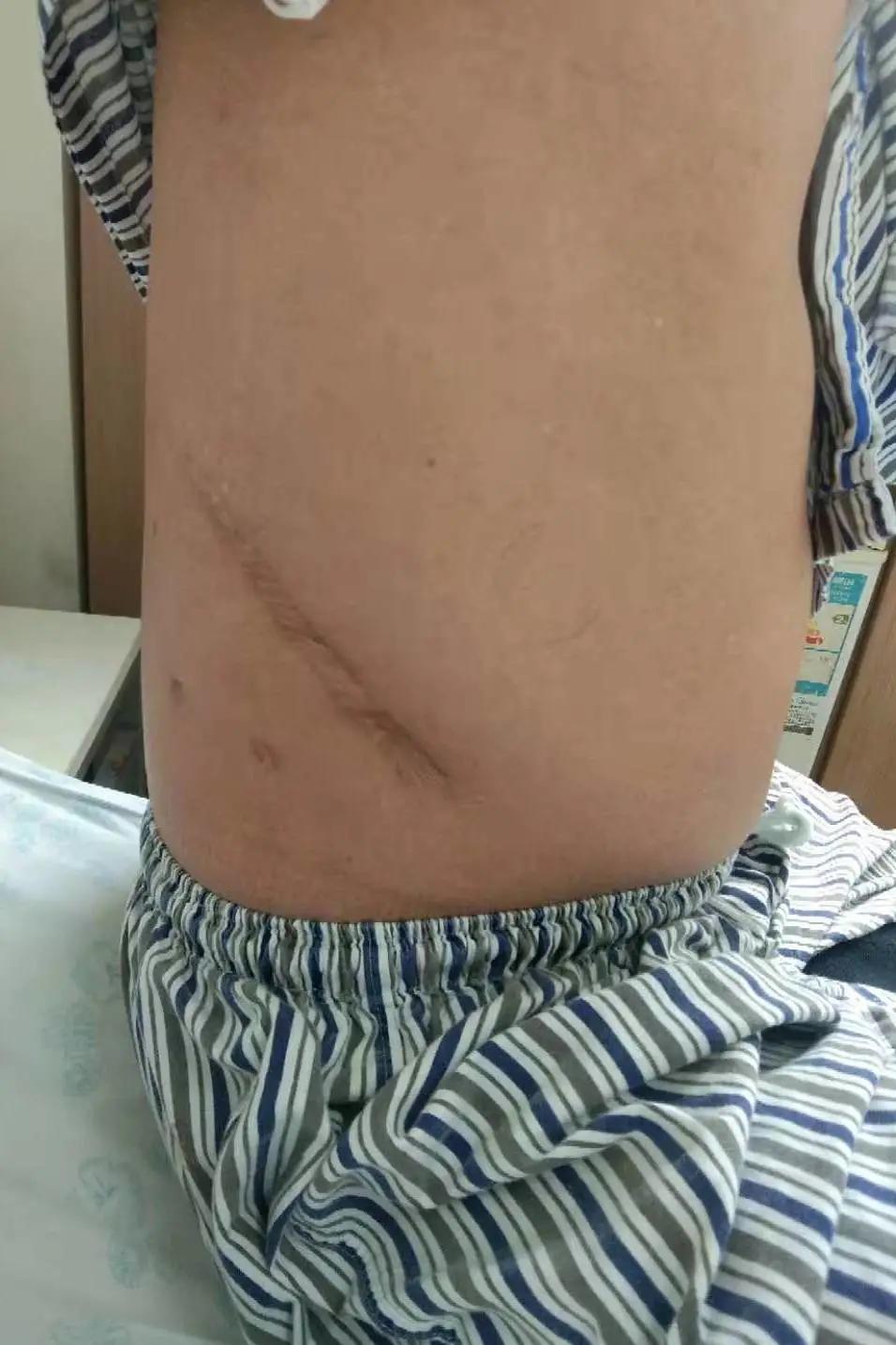 输尿管软镜碎石术安全么,输尿管软镜碎石术难受吗