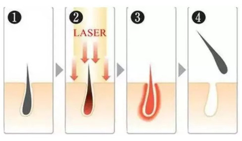 ipl光子脱毛仪和冰点脱毛仪的区别,光子脱毛和激光脱毛冰点脱毛区别