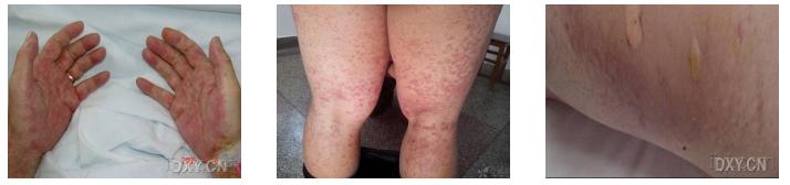 急排是什么意思,移植急排的后果