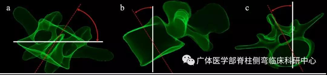 脊柱侧弯3d演示推拿,脊柱侧弯3度图片