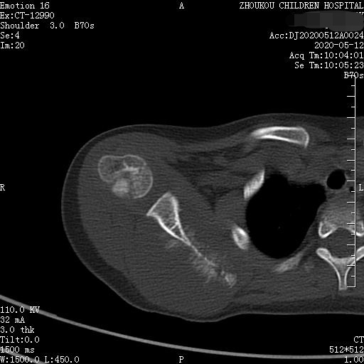 家长要警惕孩子腺样体面容,家长应该警惕孩子出现异常