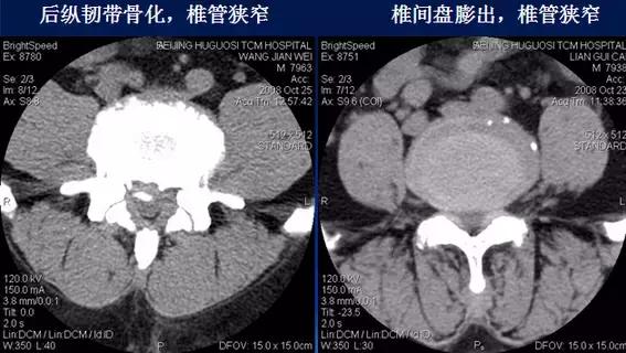 腰椎退行性变腰椎间盘轻度突出,椎间盘突出并膨出继发椎管狭窄