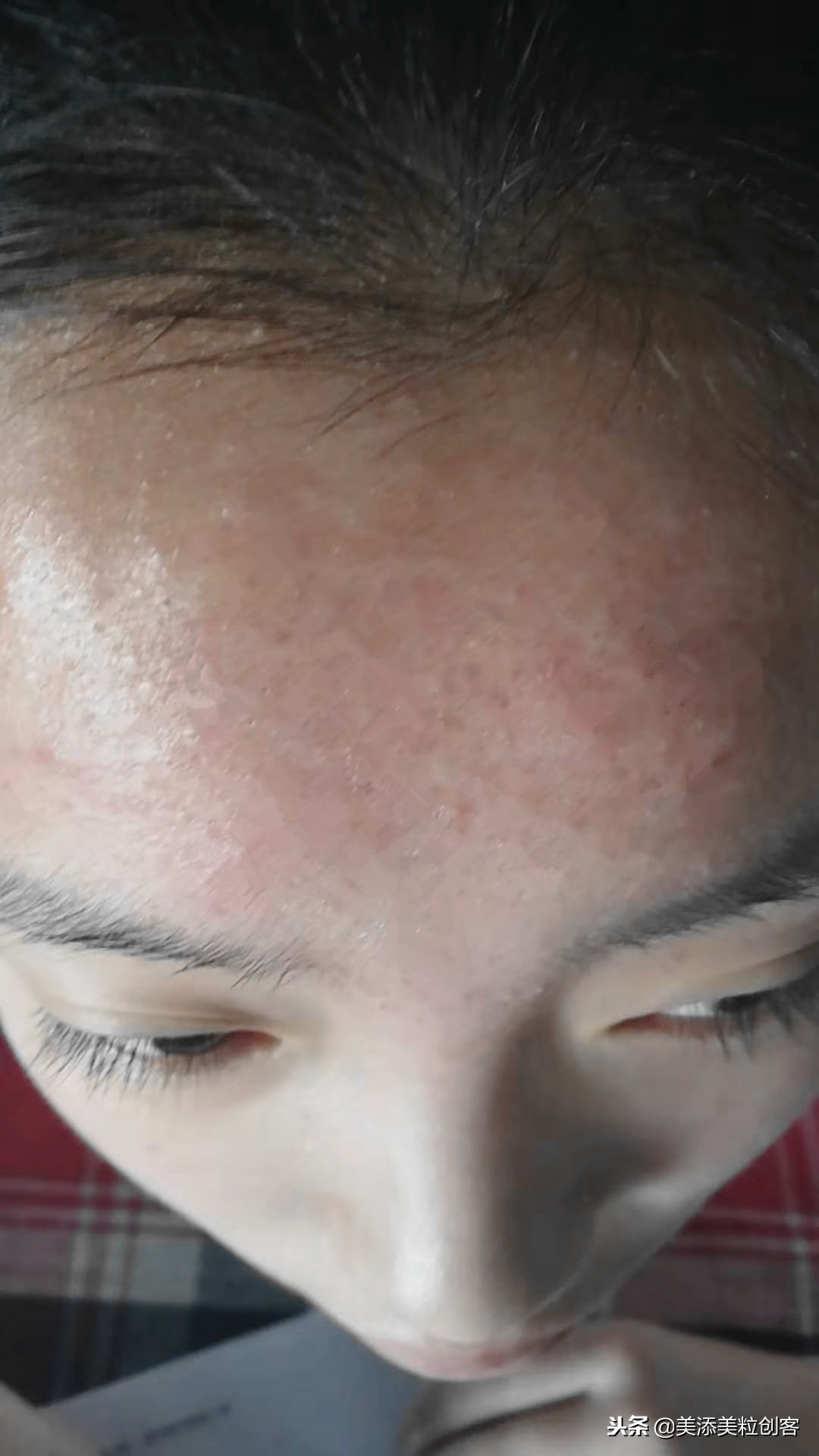 肠胃湿热症导致的闭口开口粉刺痘，这样对症而治少走很多弯路！