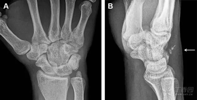 常见的八种骨折,容易漏诊的肩关节骨折
