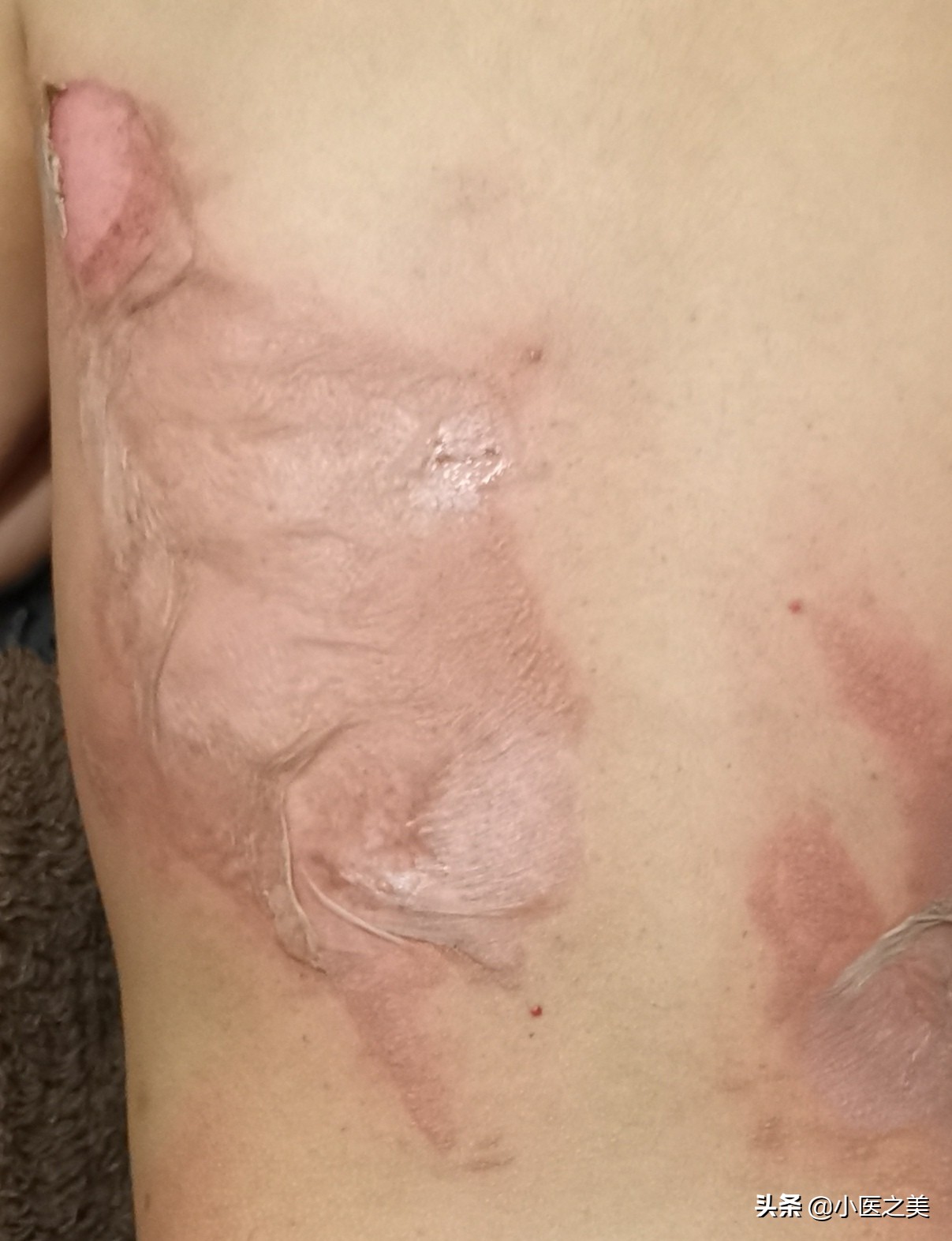 烫伤,以正确的方式治疗可帮助减轻疤痕增生