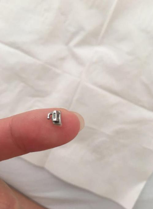 刚刚做完牙齿矫正需要注意什么,牙齿矫正结束后的注意事项