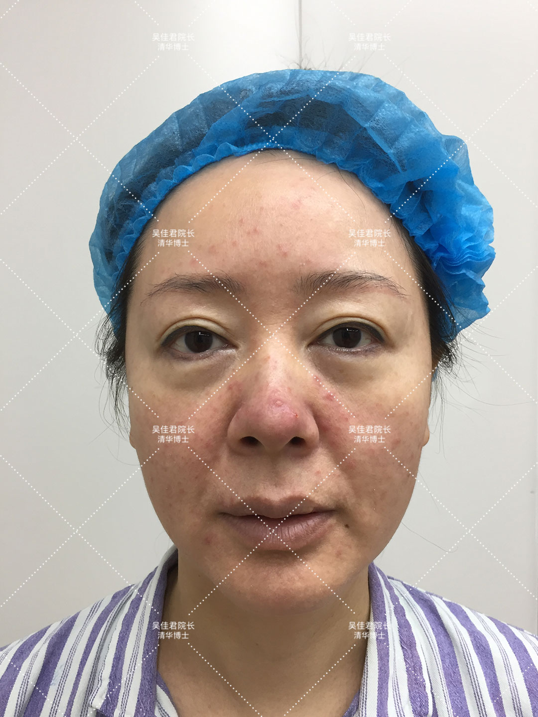 大拉皮术后50天真实感受,拉皮手术5年之后的变化