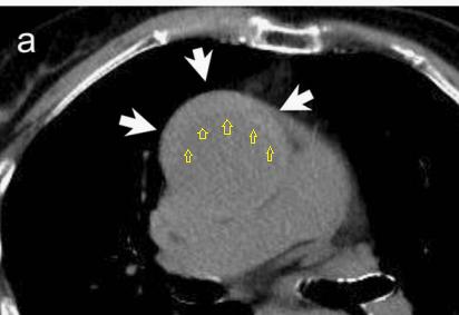 胸部Ct平扫能查出主动脉夹层吗,主动脉夹层cta影像图片解读