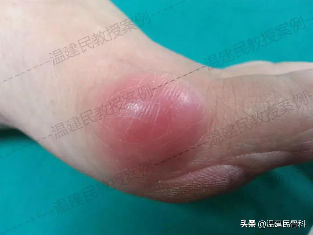 拇外翻平时走路需要注意哪些点,如何缓解拇外翻脚的痛