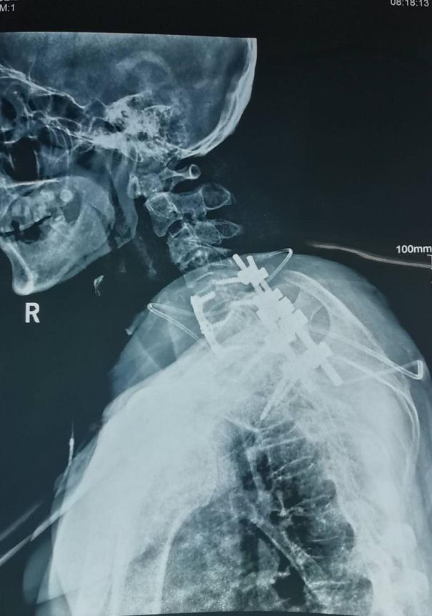 锦州市二医院骨科图片,锦州二医院颈椎手术怎么样