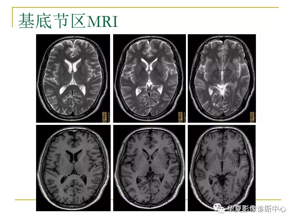 中国人脑立体定向mri应用解剖图谱,脑mri示意图
