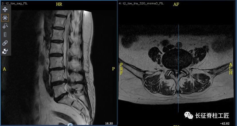老年人腰椎管狭窄可以微创手术吗,老年人腰椎管狭窄瘫痪