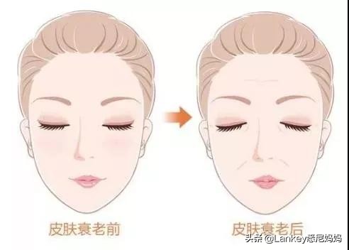 真性皱纹的定义假性皱纹的定义,一笑才有的皱纹是假性皱纹吗