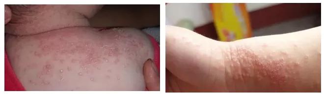 满月宝宝如何确定是奶粉过敏症状,奶粉过敏的症状和对策