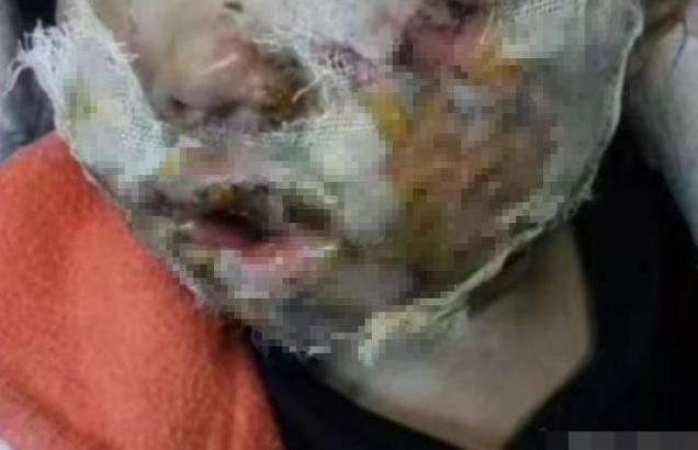 4岁女孩下巴成了“马蜂窝”，5毛一包的垃圾食品，你还给娃买吗？