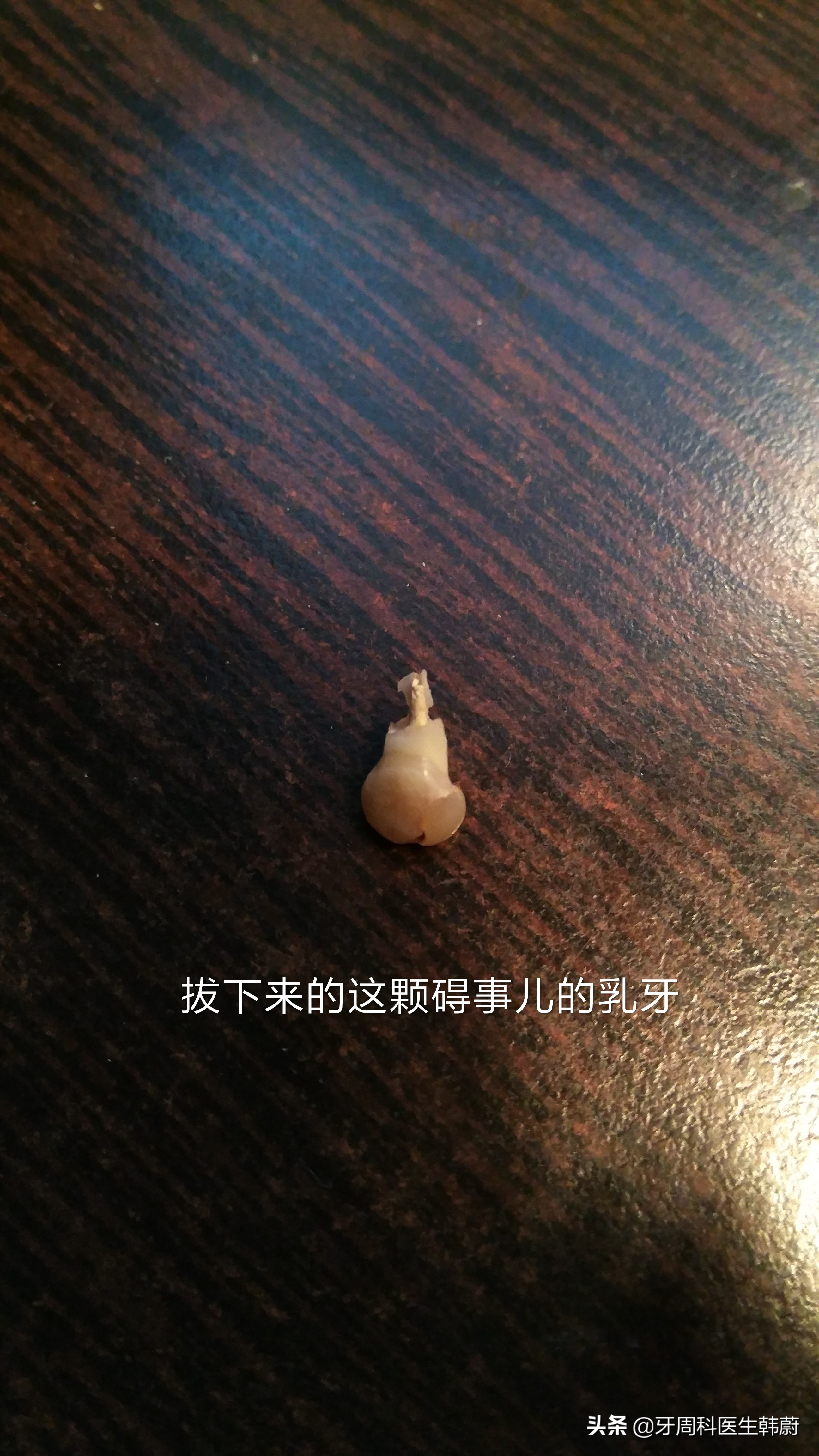 宝宝长双层牙乳牙怎么拔掉,6岁小孩长双层牙必须拔掉吗